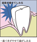 歯ぐきがやせて歯がしみる