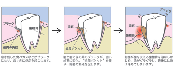 歯周病の原因と流れ